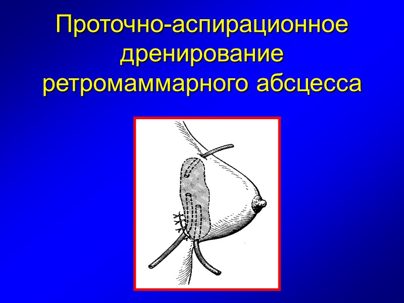 Проточно-аспирационное дренирование ретромаммарного абсцесса